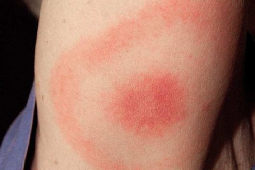 Výskyt klíšťových nemocí na Vysočině: borelióza výrazně roste, encefalitida mírně klesá