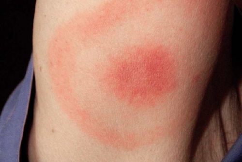 Vědci z Českých Budějovic odhalili způsob průniku borelií do lidského těla