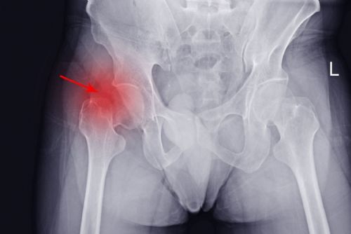 Stodská nemocnice otevírá novou ambulanci. Pomůže odhalit tichého zloděje kostí